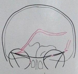 Схема к рентгеновскому снимку перелома лобной, клиновидной и височной костей с переломом основания черепа в задней проекции