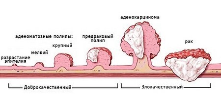 Стадии опухолей толстого кишечника: от разрастания эпителия до рака