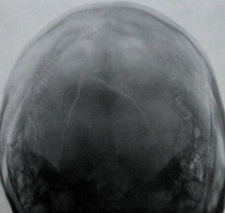 Теменно-затылочный рентгеновский снимок перелома затылочной кости
