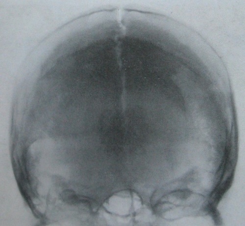 Теменно-затылочный рентгеновский снимок продольного перелома черепа с расхождением стреловидного шва