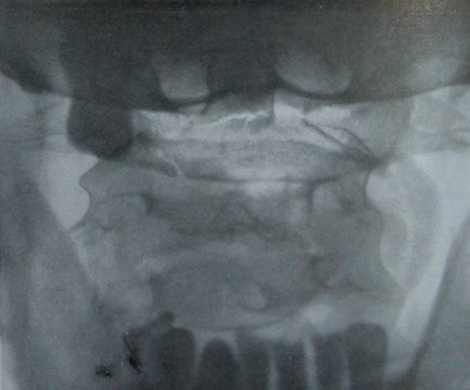 Трансоральный рентгеновский снимок переломо-вывиха атланта и эпистрофея с переломом остистого отростка 3 шейного позвонка
