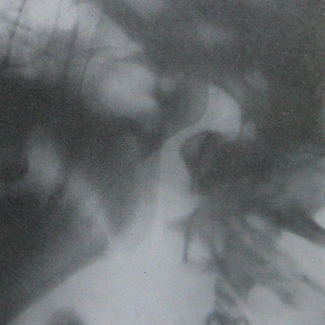 Второй рентгеновский снимок переломо-вывиха нижней челюсти в боковой проекции