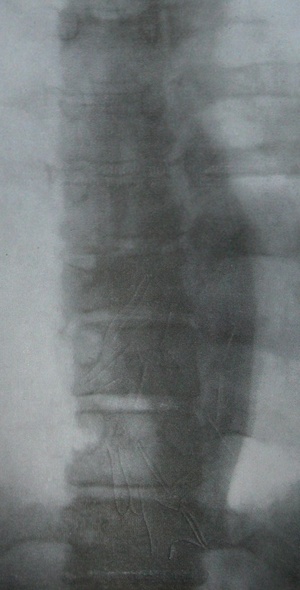Задний рентгеновский снимок компрессионного перелома 8 грудного позвонка с большой околопозвоночной гематомой