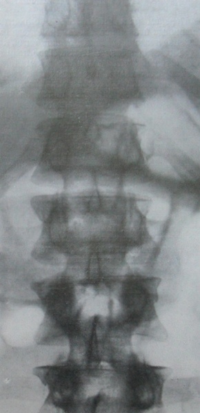 Рентгеновский снимок множественных переломов поясничных позвонков в задней проекции