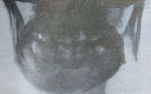 Рентгеновский снимок оскольчатого перелома нижней челюсти в задней проекции