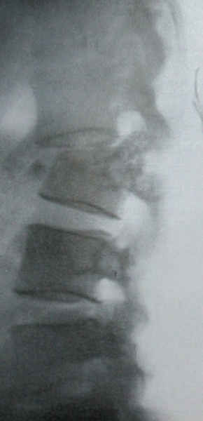 Рентгеновский снимок перелома 3 поясничного позвонка с вывихом 2 позвонка в боковой проекции