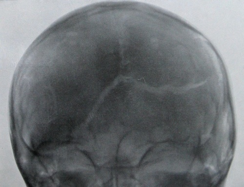 Рентгеновский снимок перелома лобной, клиновидной и височной костей с переломом основания черепа в задней проекции