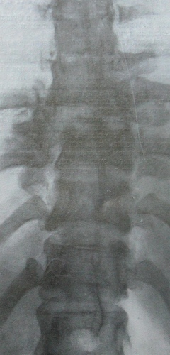 Задний рентгеновский снимок переломо-вывиха 7, 8 и 9 грудных позвонков