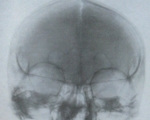 Задний рентгеновский снимок продольного перелома черепа с расхождением стреловидного шва