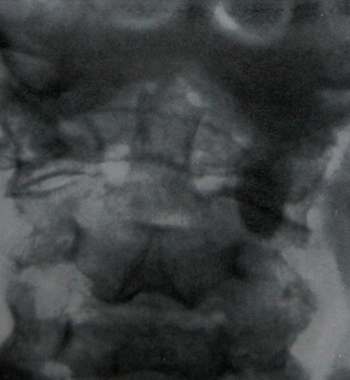 Задний снимок компрессионного переломо-вывиха атланта