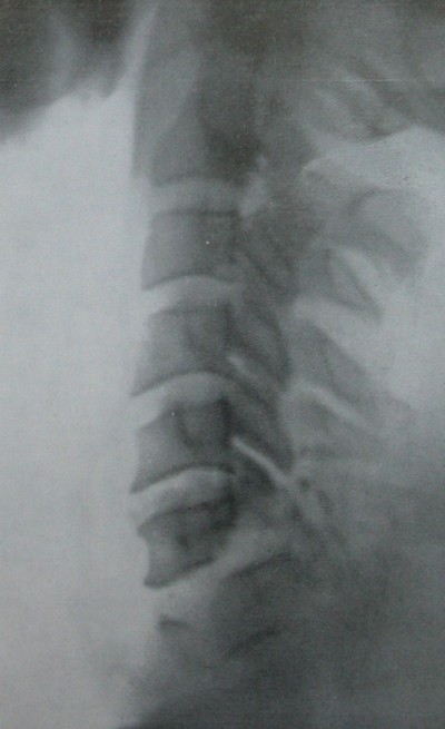 Рентгеновский снимок переломо-вывиха 6 и 7 шейных позвонков в боковой проекции