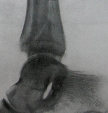 Рентгеновский снимок винтообразного перелома наружной лодыжки с подвывихом голеностопного сустава в боковой проекции