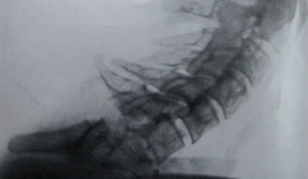 Рентгеновский снимок вывиха 6 шейного позвонка с компрессионным переломом 7 позвонка в боковой проекции