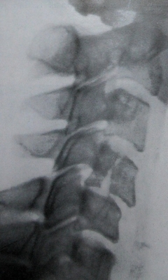 Боковой рентгеновский снимок вертикального перелома 4 шейного позвонка