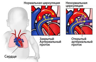 Схема циркуляции крови при открытом артериальном протоке