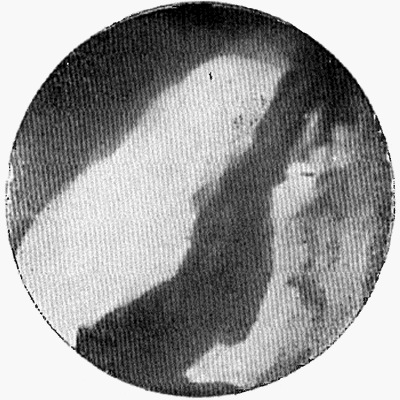 Рентгеноскопия при деформации луковицы двенадцатиперстной кишки газами толстой кишки. Второе косое положение.