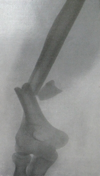 Рентгеновский снимок перелома плечевой кости в нижней трети диафиза в задней проекции по отношению к дистальному отломку