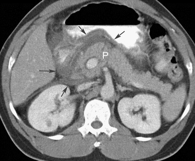 Компьютерная томография в диагностике хронического панкреатита
