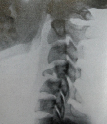 Рентгеновский снимок компрессионного перелома 4 шейного позвонка
