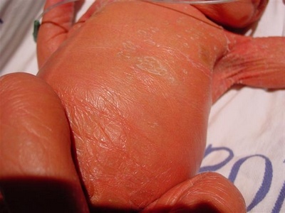 Кожа ребенка, больного врожденной ихтиозоформной эритродермией Брока: она грязно-темно-желтого цвета и напоминает кожу крокодила