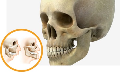 Микрогнатия верхней и нижней челюсти