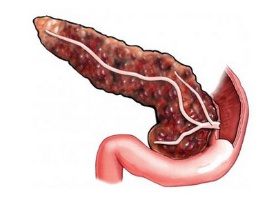 Панкреатит - частая причина обызвествления поджелудочной железы