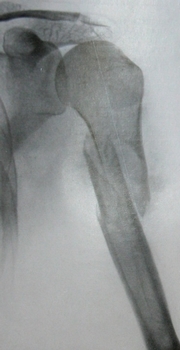 Рентгеновский снимок перелома плечевой кости в верхней трети диафиза в прямой проекции