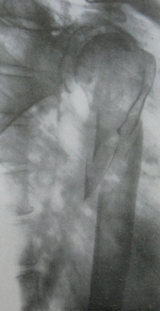 Трансторакальный рентгеновский снимок перелома плечевой кости в верхней трети диафиза в прямой проекции