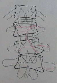 Схема к снимку перелома 1-2 поясничных позвонков и их дуг в прямой проекции