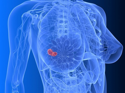 Рак груди - причина проведения пластической операции