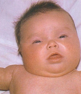 Лицо ребенка, страдающего врожденным гипотиреозом