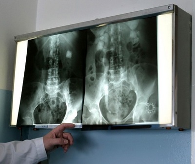 Методика рентгенологической диагностики злокачественных опухолей тонкой кишки