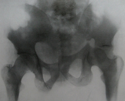 Рентгеновский снимок в прямой проекции центрального вывиха в тазобедренном суставе