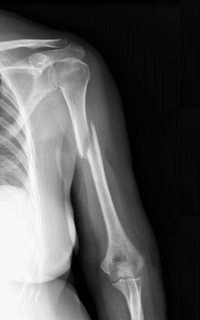 Рентгеновский снимок перелом диафиза плечевой кости