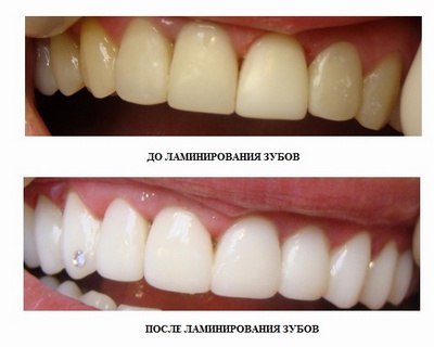 Результаты ламинирования зубов фарфоровыми пластинами