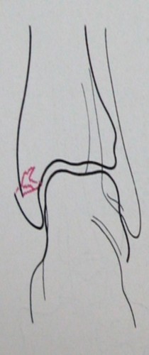 Схема к рентгеновскому снимку изолированного перелома внутренней лодыжки в задней проекции
