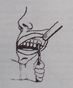 Техника удаления первого и второго моляров правой верхней челюсти при помощи щипцов