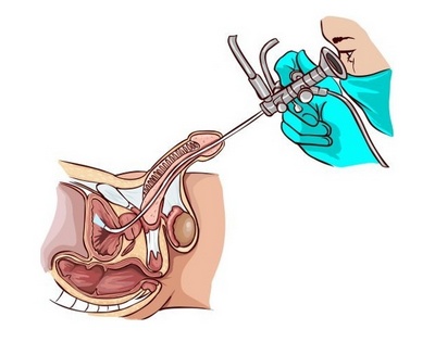 Уретроскопия - эндоскопическая методика исследования уретры