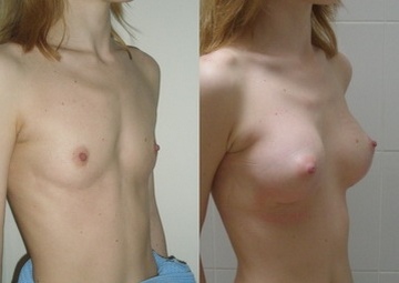Увеличение груди - самая распространенная причина пластических операций на молочных железах