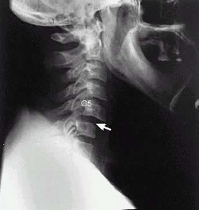 Рентгенограмма вывиха нижнего шейного позвонка