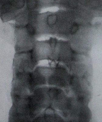 Задний рентгеновский снимок вертикального перелома 4 шейного позвонка