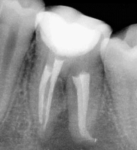 Рентгеновский снимок запломбированного зуба