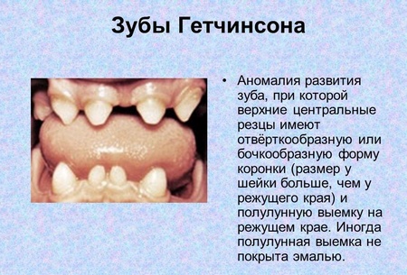Зубы Hutschinson’a (Гетчинсона) - разновидность дистрофии формы отдельных зубов