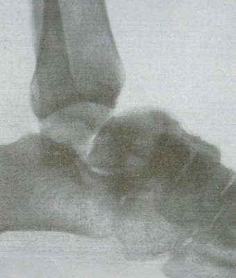Рентгенологический снимок вывиха таранной кости в боковой проекции