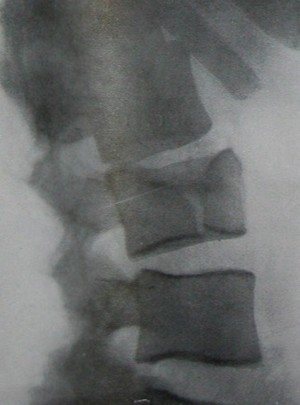 Боковой снимок перелома 3 поясничного позвонка по продольной оси