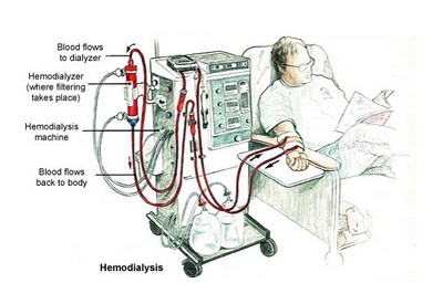 Проведение процедуры гемодиализа