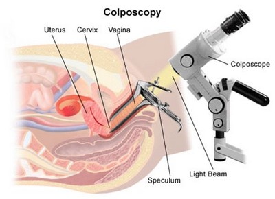 Кольпоскопия - способ диагностики эрозии шейки матки