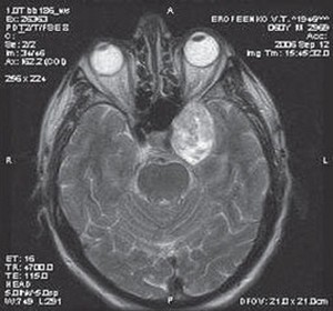 МРТ головного мозга больного с синдромом Толоса-Ханта