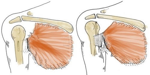 Отрыв сухожилия грудной мышцы