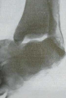 Рентгенологический снимок вывиха таранной кости в прямой проекции